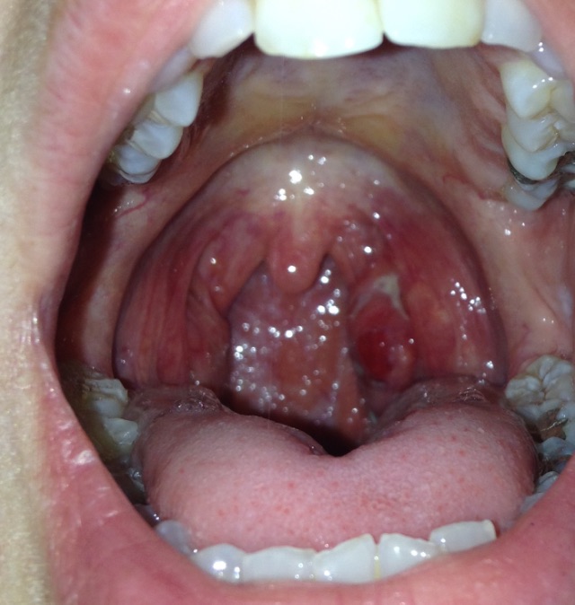How to get rid of white spots on tonsils